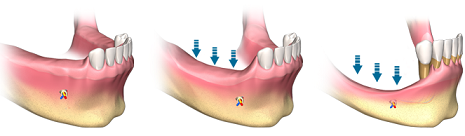 Bei Osteoporose Patienten kann es zu Komplikationen bei der Implantation kommen, weshalb der Zahnarzt über die Erkrankung zu informieren ist.