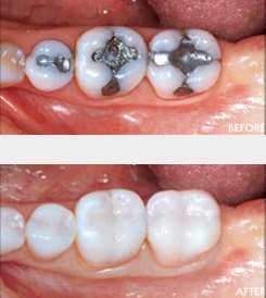 Zahnfüllung  Keramik oder Amalgam? Zahnarzt Dr. Seidel