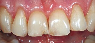 Bei unschönen Schäden durch Karies können Kronen die Ästhetik und Zahnfunktion wieder zurückbringen.