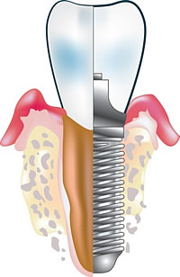 Durch Implantationen kann Ihnen Ihr Zahnarzt schöne Zähne schenken, die zudem echten Zähnen in ihrer Funktion nicht nachstehen.